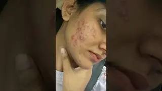 Remove pimples from vestige products #vestige #vestigeproducts #vestigepvtlimited