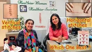 Normal Delivery And Cesarean Delivery | Vertical And Horizontal Absorbable Stitches Which One Best ?