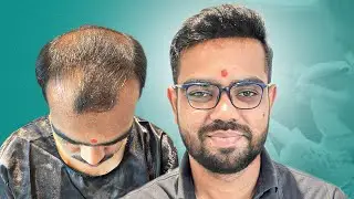 He Started With Grade 5 Baldness&hellip; Look at His Hair After 5 Months 😍 | Kolhapur | New Roots