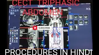 cect triphasic abdomen Full procedures in (hindi).