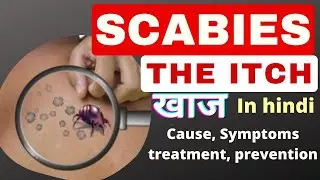 scabies in hindi | the itch | cause, symptoms, treatment, | खुजली | MSN | GNM | Bsc nursing 2nd