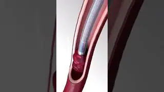 How Blood Clots Are Removed | 3d animation #bloodclotting #stroke #vascularsurgery #thrombectomy