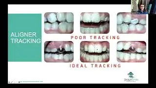Posterior Open Bite and Aligners