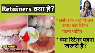 retainers after braces / retainer क्या हैं ? कितने समय तक पहना पड़ेगा?