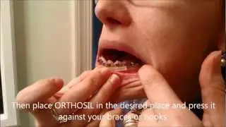 Lips Protection: ORTHOSIL Brace Wax and Comfort Cover for playing sports