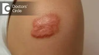 Can Lasers help patients with burn marks? - Dr. Pavan Murdeshwar