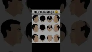 &ldquo;Stages of Male Pattern Baldness | Understanding Hair Loss Progression&rdquo;