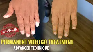 Vitiligo whitepatch coverup tattoo on fingers | Real time live process | Machu Tattoos