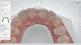 3Shape Clear Aligner Studio Unveiled | 3Shape | Oblu Healthcare | Future Is Innovation