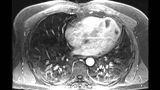 Sarcoma metastases to heart