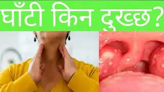 throat pain in nepali|Dr Bhupendra Shah|doctor Sathi
