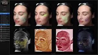 VISIA ANALYSIS IN TORONTO AND NORTH YORK