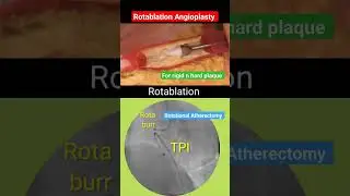 Rota Angioplasty l Rotational Atherectomy l Hard plaque #shorts