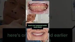 Veneers WITHOUT shaving your teeth!😁| 2023 update #shorts #dentallan #veneersturkey #veneers