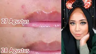 REVIEW Naruko Tea Tree Series: SKINCARE JERAWAT!!! | Aro Kopa