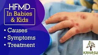 Kanasu Preschool & Daycare | HFM Disease | Viral Infection Common in Young Children