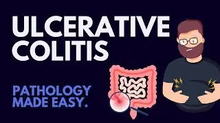 Ulcerative Colitis Pathology, Simply Explained!