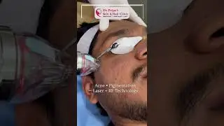 Fraxis Duo Acne Scar Treatment | Advanced Laser Dermatology in Bangalore