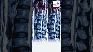Hip Replacement in Young individuals by Dr. Vishal Kasliwal.