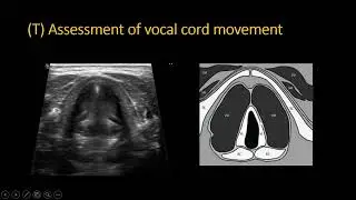 Airway Ultrasound in Bahasa Malaysia