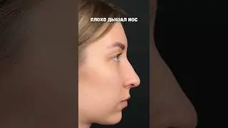 РИНОСЕПТОПЛАСТИКА В 28 ЛЕТ 🔥