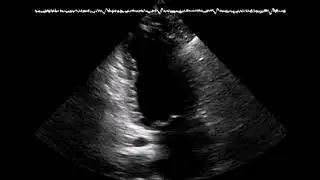 Cardiotoxicity from chemotherapy (cardio-oncology) An echocardiography case and discussion