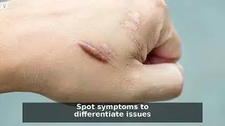 Piercing Bump vs Keloid: 5 Key Differences & Treatments