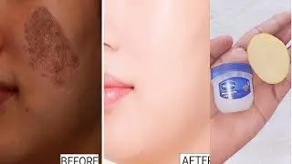 Vaseline and potato for pigmentation removal | Vaseline on face | Vaseline uses 