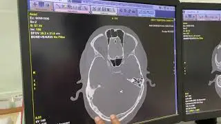 How To Filming Hrct Temporal Bone/ Filming of Hrct Temporal Bone