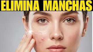 10 Remedios Caseros para Quitar Manchas y Acn&eacute; Naturalmente