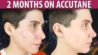 Accutane for Persistent Mild Acne &mdash; 2 Month Update