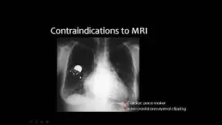 MRI of Chest lesions   Prof Dr  Mamdouh Mahfouz In Arabic