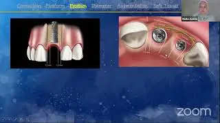 Peri-implant soft tissue stability using either guided bone regeneration Vs connective tissue graft