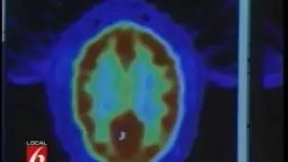 PotTV - Alzheimer's? Forget About It