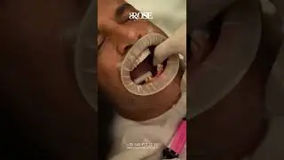 Experience the Beauty of Rose Medical's Expert Touch in Crafting Perfect Dental Bridges!