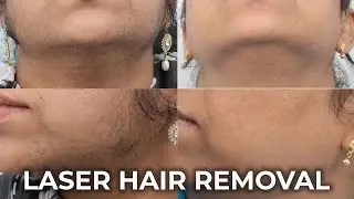 Effective Laser Hair Removal for Hirsutism | Soprano Titanium Technology&nbsp;at&nbsp;Hash&nbsp;Clinic