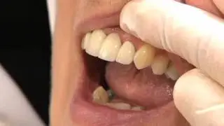 Le nettoyge d'un pont fixe