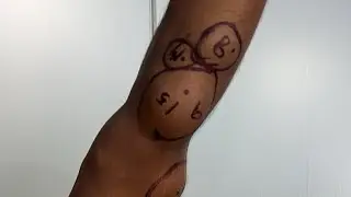 Multiple Lipoma Removal Live Before Surgery ! चर्बी की गाँठ का इलाज #lipoma #lipomatreatment