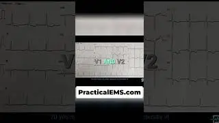 EKG Analysis: Spotting Ischemia & Infarction in Heart Waves #shorts