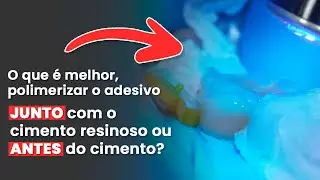 SERÁ QUE O MELHOR É POLIMERIZAR O ADESIVO JUNTO COM O CIMENTO RESINOSO? - Mylene e Renato