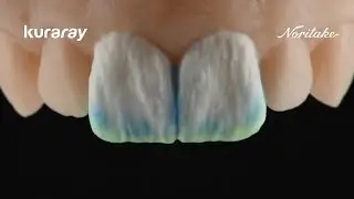 How to Create BL2 Veneers | Micro-Layering with CERABIEN MiLai