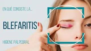 Blefaritis: ¿Qué es y cómo se trata?