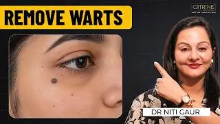 Understanding Skin Warts: Causes, Types, and Treatment Explained by Dr. Niti Gaur | Citrine Clinic