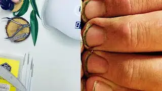 😱#prosthesisnail#nailcare#artificialnail#nailstory##изготовление#ноготь#уходза#love#nails#art