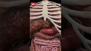 World Liver Day: Modern Disease Haunting the World