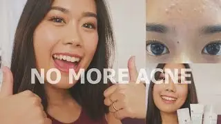 HOW I GOT RID OF ACNE | Acne.org & Paula's Choice Review