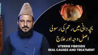 Uterine Fibroids &ndash; Real Causes and Treatment | بچہ دانی میں رحم کی رسولی
