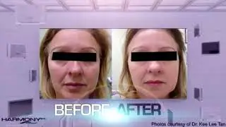 ClearLift laser In the News!