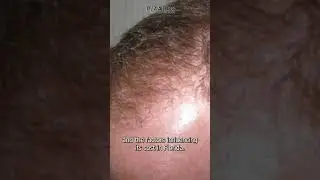 Hair Transplant Cost in Florida and Your Affordable Options