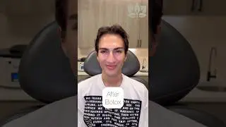Before & After Botox | Forehead, Crow&rsquo;s Feet & More